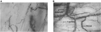 Case Report: Endothelial Glycocalyx Damage in Critically ill Patients With SARS-CoV-2-Related Multisystem Inflammatory Syndrome (MIS-C)
